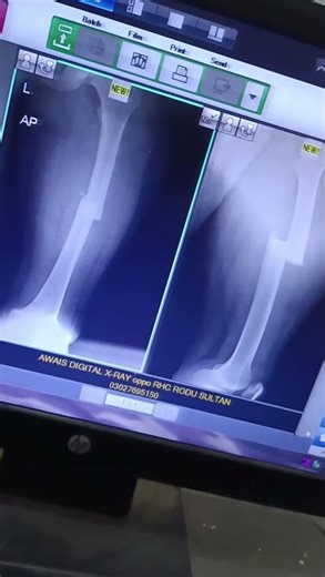 femur x Ray PA view and lat