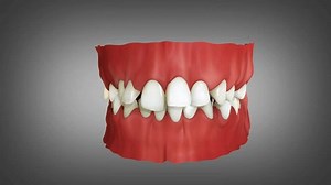 Three Sets Clear Aligner Invisalign Braces Stock Footage Video (100% Royalty-free) 3762629473 | Shutterstock