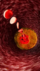 Fat clogs the arteries in the body. LDL. low-density lipoproteins.3d rendering. Chronic non-communicable diseases. Causes of heart disease. Sickness. Dangerous to health.3D rendering