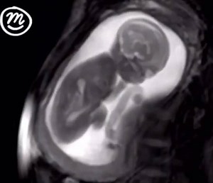 This is the most detailed MRI scan taken of a preborn baby. The amazing video shows a child at 20 weeks moving, turning her head, and kicking. The child’s beating heart can also be seen!⠀⠀⠀⠀⠀⠀⠀⠀ Video credit and info: http://ChannelMum.com and http://iFindProject.com HatTip: Live Action www.ChooseLife.nz | Family First New Zealand