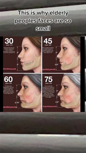 Understanding Bone Resorption of the Mandible
