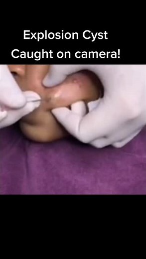 Cyst explosion #fyp #pimple #popper #spot #zit