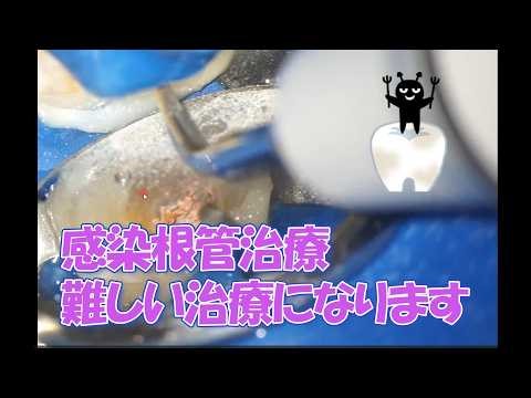 Retreatment of tooth roots, infected root canal treatment