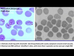 24- Practical Parasitology - Plasmodium Falciparum - Ring Stage