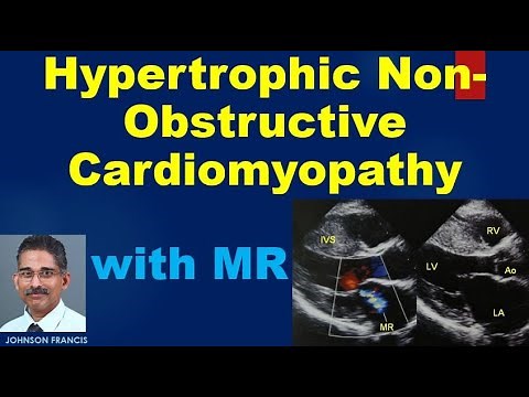Hypertrophic Non Obstructive Cardiomyopathy