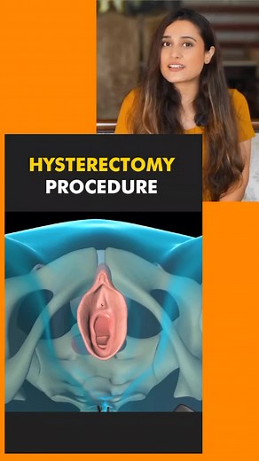 Hysterectomy Procedure 3D Animation #hysterectomy #hysterectomyrecovery #hysterectomysurgery #hysterectomyjourney #hysteroscopy #hysteroscope #hysteroscopysurgery #hysteroscopicmyomectom #for #fyp #trending