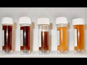 Cola Colored Urine, Coke Colored Urine, Dark Colored Urine, Cocoa Colored Urine ; Definition, Causes