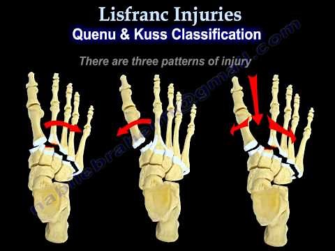 Lisfranc Injuries - Everything You Need To Know - Dr. Nabil Ebraheim