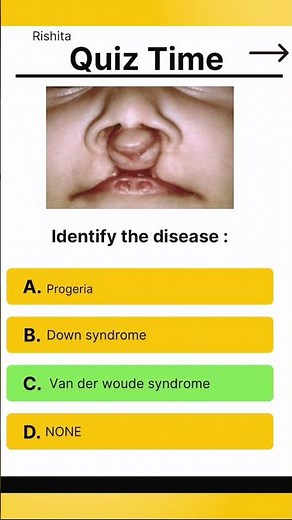 Identify the syndrome from image | Syndrome | NEET MCQ daily practise #bds #dental #neet #medico