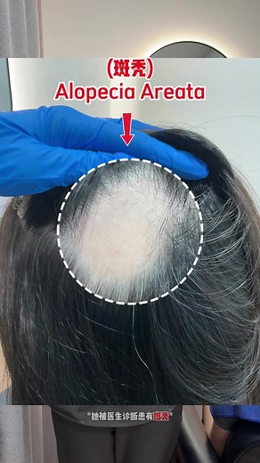 解决顾客斑秃的问题，重拾自信