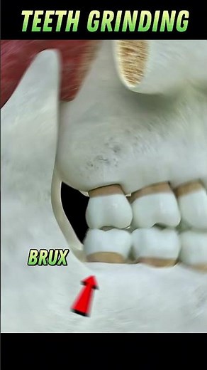 Why You Grind Your Teeth at Night — And How to Stop It Fast