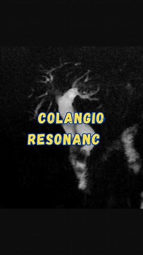 Colangio resonancia, ¿cuál es el diagnóstico? 🤓 #radiologia #radiology #resonancia #mri