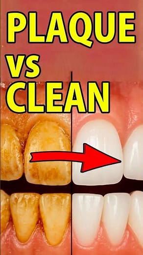 Plaque vs Clean Teeth — The Difference
