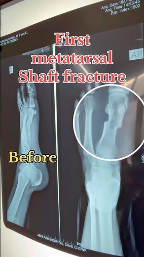Metatarsal fractures management with pop #popcast #fracture #attarpilesclinic