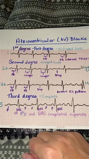 Understanding AV Blocks: Simplifying the Complexities