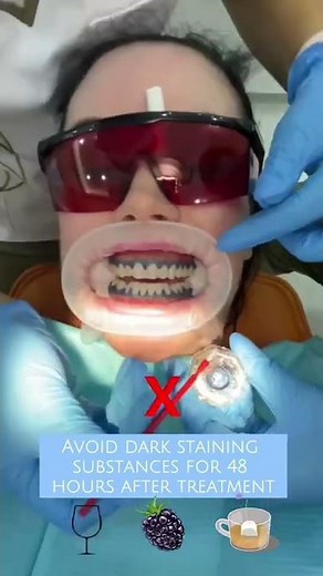 Before & After- Laser teeth whitening in 60 secs