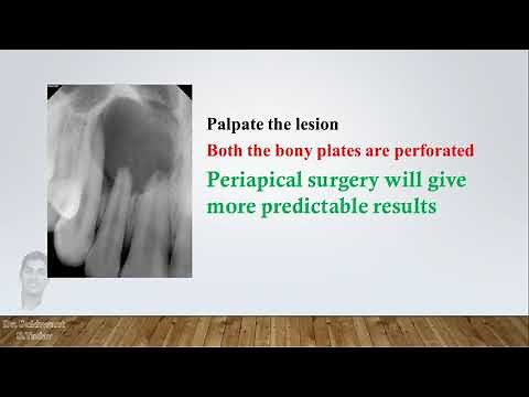 Large Periapical lesion- Treatment Approach