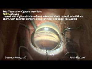 Cypass Microstent for treatment of Glaucoma. In 4K. 7-9-17.