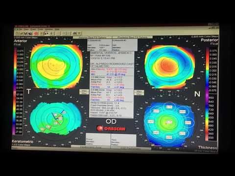 Topografía Corneal