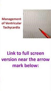 Management of Ventricular Tachycardia
