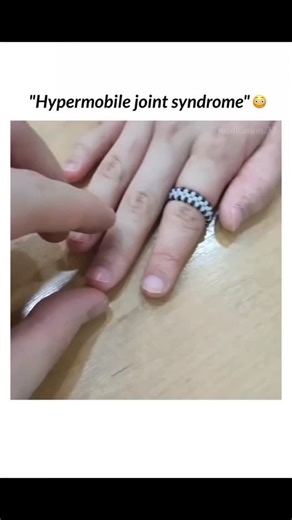CurioZone on Instagram: "Hypermobile joint syndrome or Ehlers-Danlos syndrome (EDS) is a condition characterized by extremely flexible joints, including fingers that can bend beyond the normal range, sometimes up to 180°. This is due to the connective tissue supporting the joints being more elastic, allowing for increased flexibility. Individuals with EDS may experience joint instability, frequent subluxations, or dislocations. While hypermobility can be beneficial in certain contexts, it can al
