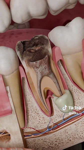 Understanding Acute Apical Abscess in 3D Anatomy