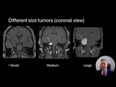 Acoustic Neuroma / Vestibular Schwannoma Tumor: Introduction and Discussion