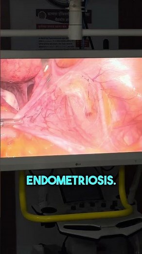 Endometriosis Myths vs Facts!