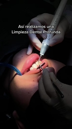 ¡Así es como se realiza una Limpieza Dental Profunda! Este tratamiento se debe realizar mínimo 2 veces al año para una buena salud bucal, y tú ¿ya te realizaste tu primera limpieza dental? Separa tu cita al📱993 149 124 #limpiezadental #limpiezadentalprofunda #profilaxis #destartrajedental #sarrodental #tratamientosdentales #esteticadental #fyp #parati #dental #dentista