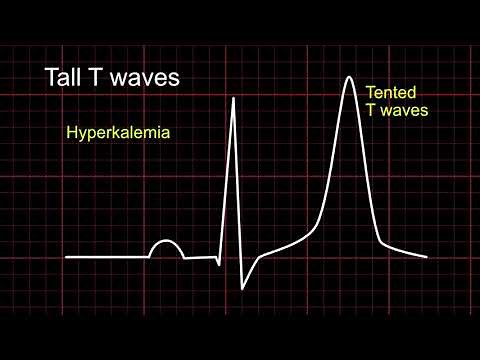T waves : ECG for dummies XI