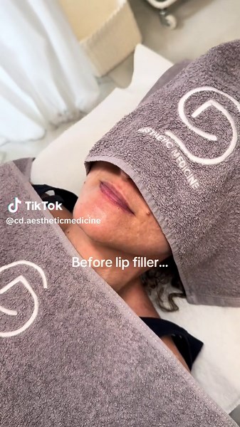 Lip filler in progress ✔️💉✨ Get yours now : 📍110 Vasilissis Sofias Avenue , zip code : 11527, 1st floor 📲 306972898413 or DM us📩 #fyp #foryou #lipfillerinprogress #lipfillerathens #lipfiller #lipaugmentation #lipinjections #aestheticmedicine