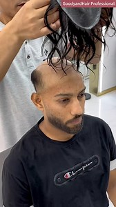 143K views · 527 reactions | ✨ Our Hair Replacement Systems are...