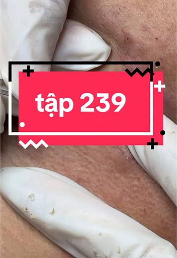 Skin Extraction Procedure: Blackhead Removal Techniques