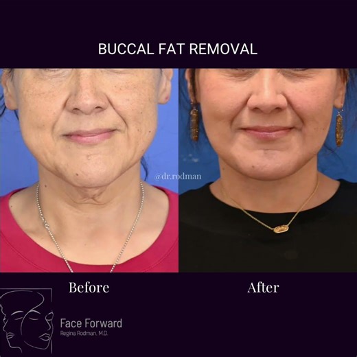 Buccal Fat Removal| Before and After| Plastic Surgery