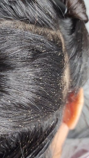 Extreme Head Lice Infestation #RGVLiceLady | LRS - Lice Removal Service