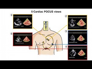 5 cardiac POCUS views image acquisition with Butterfly iQ