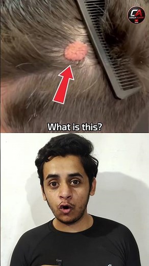 Nevus Sebaceous in head