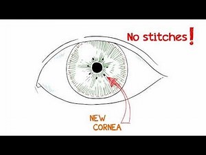 What is a Cornea Transplant?