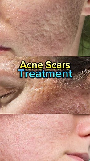 Effective Acne Scar Treatment Methods for Different Scar Types