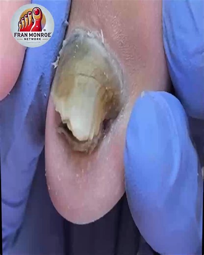 Smart Ways to Maintain Overgrown Toenails That Reduce Pain Naturally #NailFixTips #ThickToenailCare #HomeNailCare #SafeNailCare | Fran Monroe