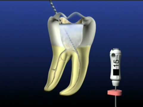 how to use protaper rotary files