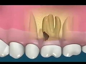 Root amputation بتر الجذر