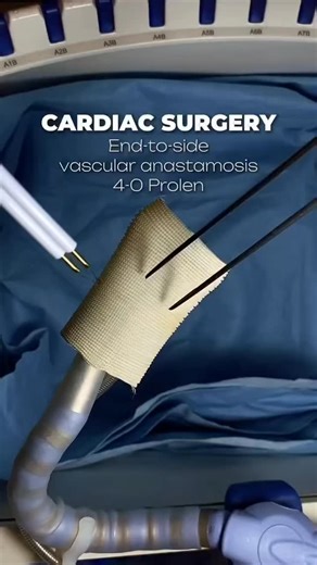 @doctor.hoon.bhai on Instagram: "Witness the intricacies of #CardiacSurgery — an end-to-side vascular anastomosis using precision 4-0 Prolene sutures. 🩺✨ This procedure highlights the remarkable synergy between advanced surgical techniques and innovative medical devices that save lives every day.Every stitch in cardiac surgery represents hope, meticulous attention, and the relentless effort of a dedicated surgical team working in harmony. End-to-side anastomosis is a cornerstone technique, esse
