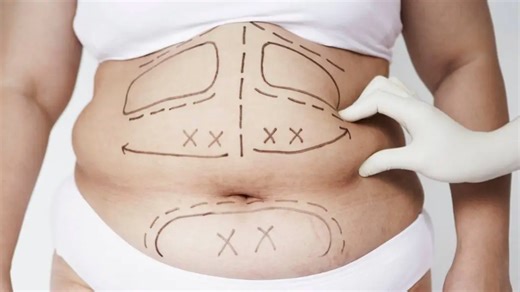 Is Liposuction Safe in Singapore? Risks, Side Effects & What Research Shows
