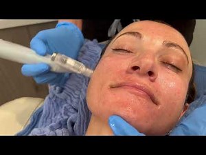 PRP + Microneedling with the new Eclipse Micropen EVO