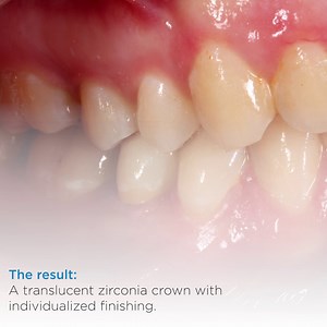 "Thanks to the newly achieved CEREC workflow time, this restoration...