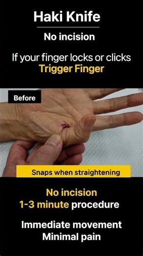 Thumb Clicking & Pain? Watch This Movement Change #triggerfinger #handsurgery #hakiknife