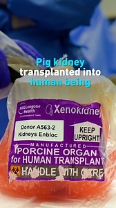 2.4K views · 13 reactions | The recent transplanting of a gene-edited pig organ into a human being in Alabama marks the fifth time an American has undergone the experimental procedure, putting an end to eight years of dialysis for the patient. Meet the key participants in the latest effort to save human lives with animal organs. | CGTN America | Facebook