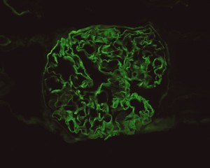 Differential Diagnosis of Hemoptysis