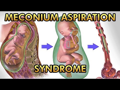 Meconium Aspiration Syndrome: Pathophysiology, Signs and Symptoms, Diagnosis and Treatment
